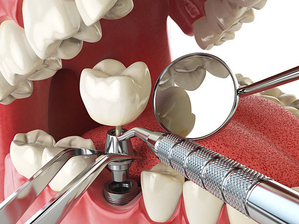 Best Broken or Cracked Tooth Emergency Dentist in Springfield, OR